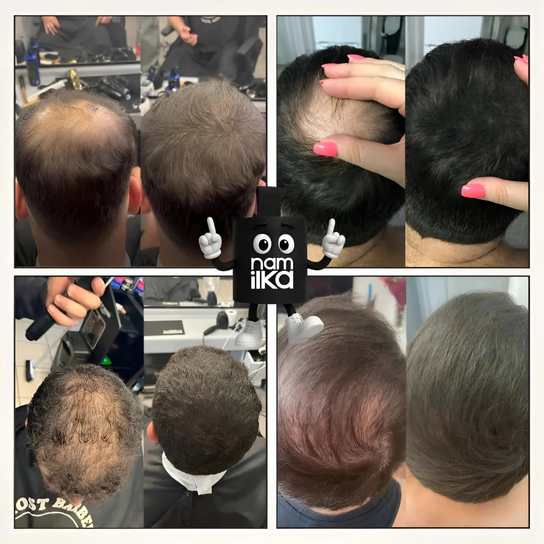 Camouflage capillaire instantané – Image 2